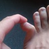 足の小指が骨折した症状！全治何ヶ月で治療できる？